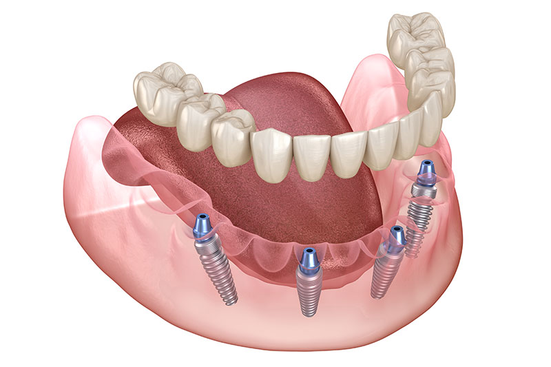 All on 4 Dental Implants in Concord