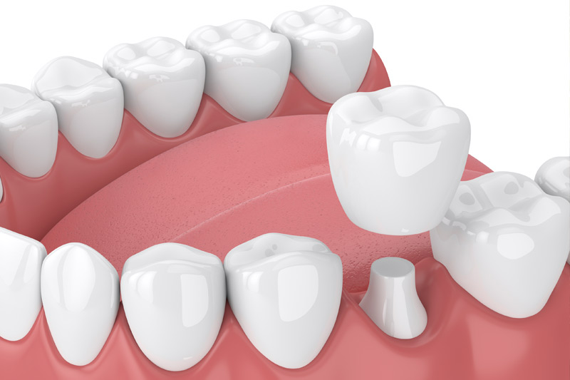 Dental Crowns in Concord