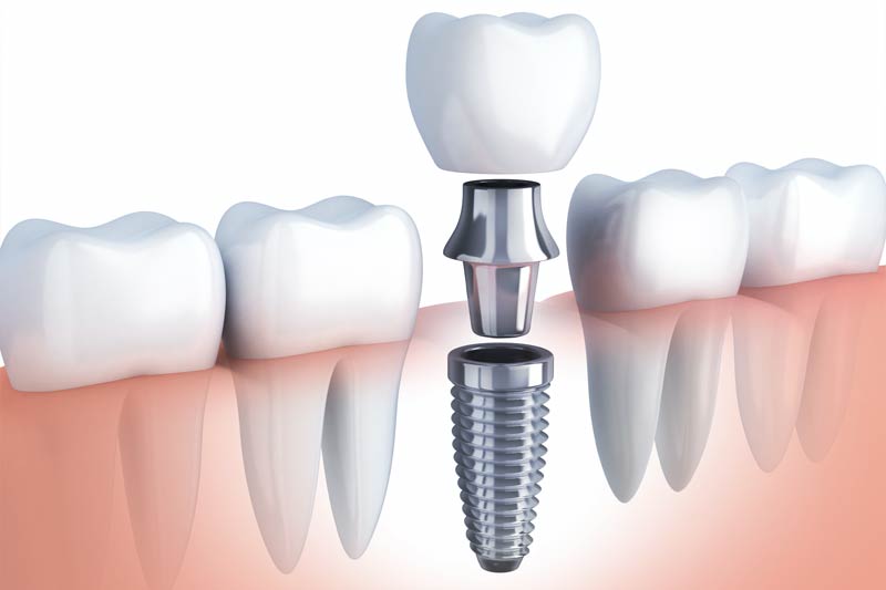 Dental Implants in Concord