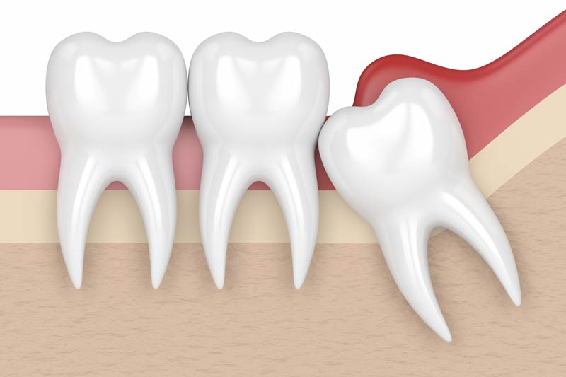 Wisdom Tooth Removal in Concord
